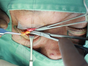 3.手術中　経結膜脱脂の様子